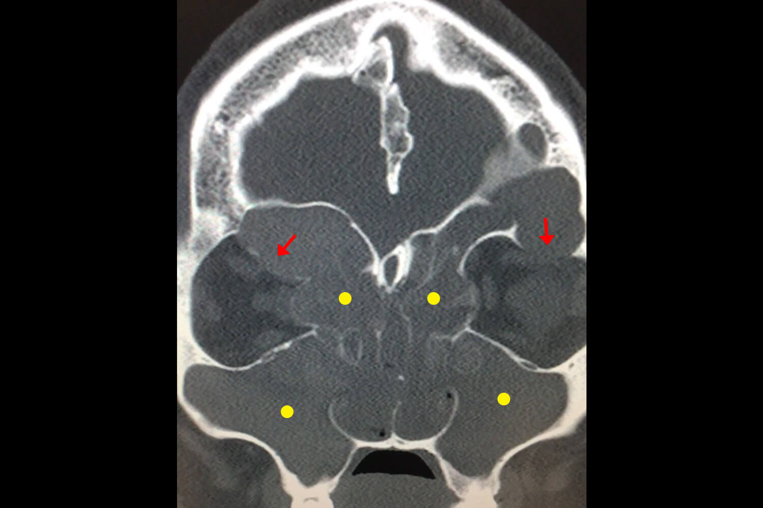 Allergic Fungal Sinusitis Dr Aykut Unsal Philadelphia