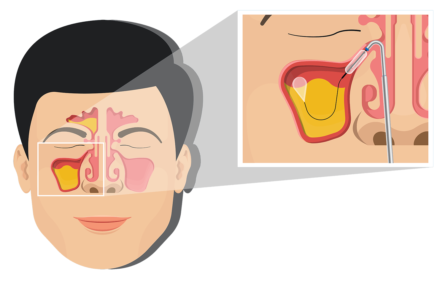 Синус пластика. Синус пластика тренировка на яйце. Balloon nose форма.