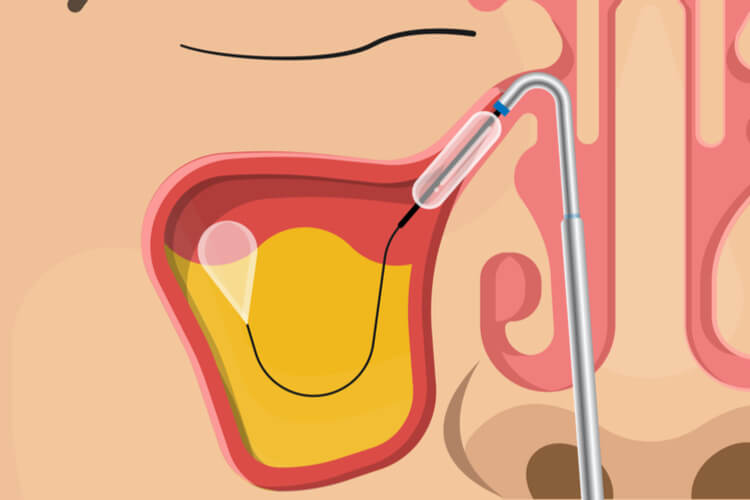 balloon-sinuplasty-diagram