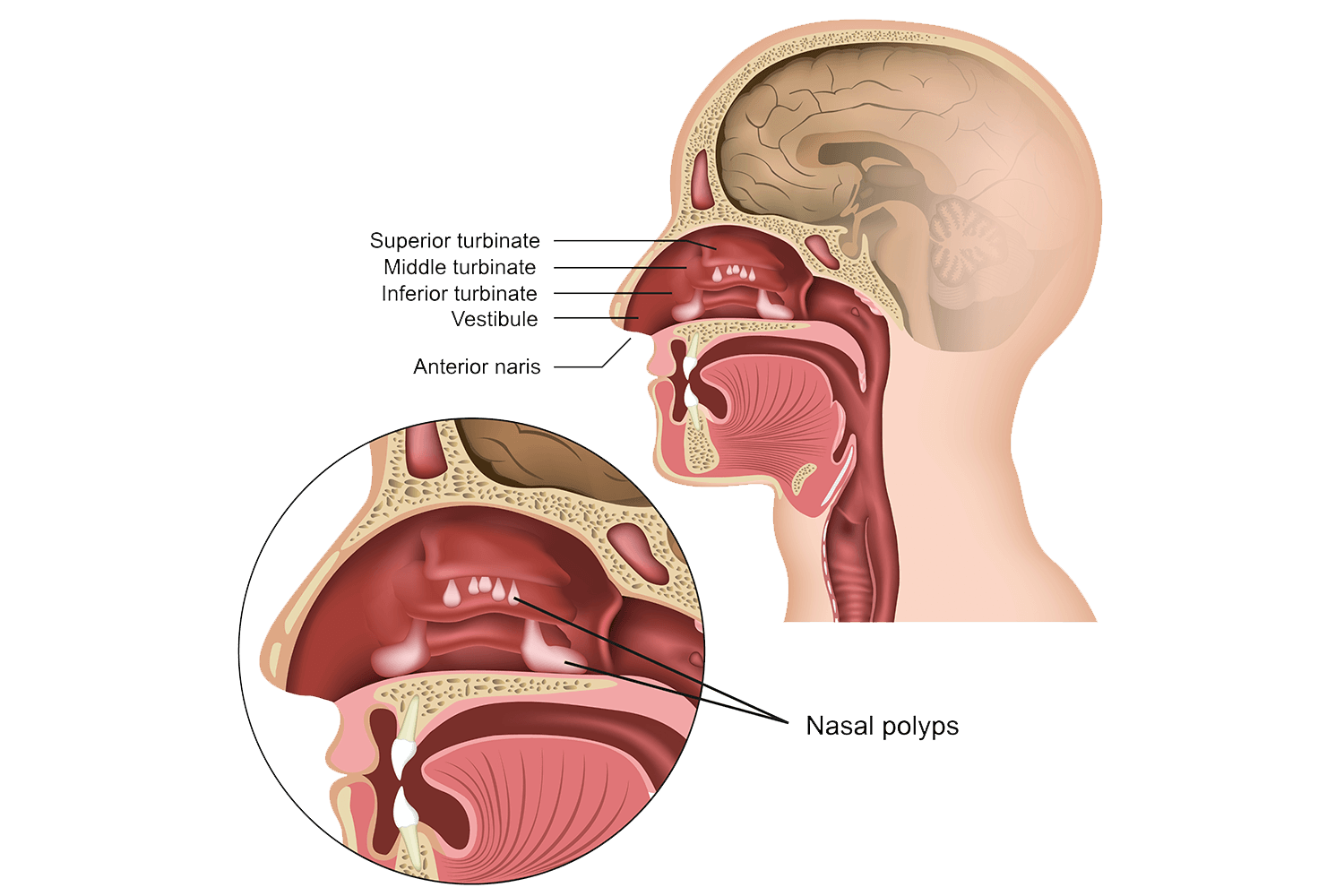 Nasal Polyps Dr Aykut Unsal Philadelphia