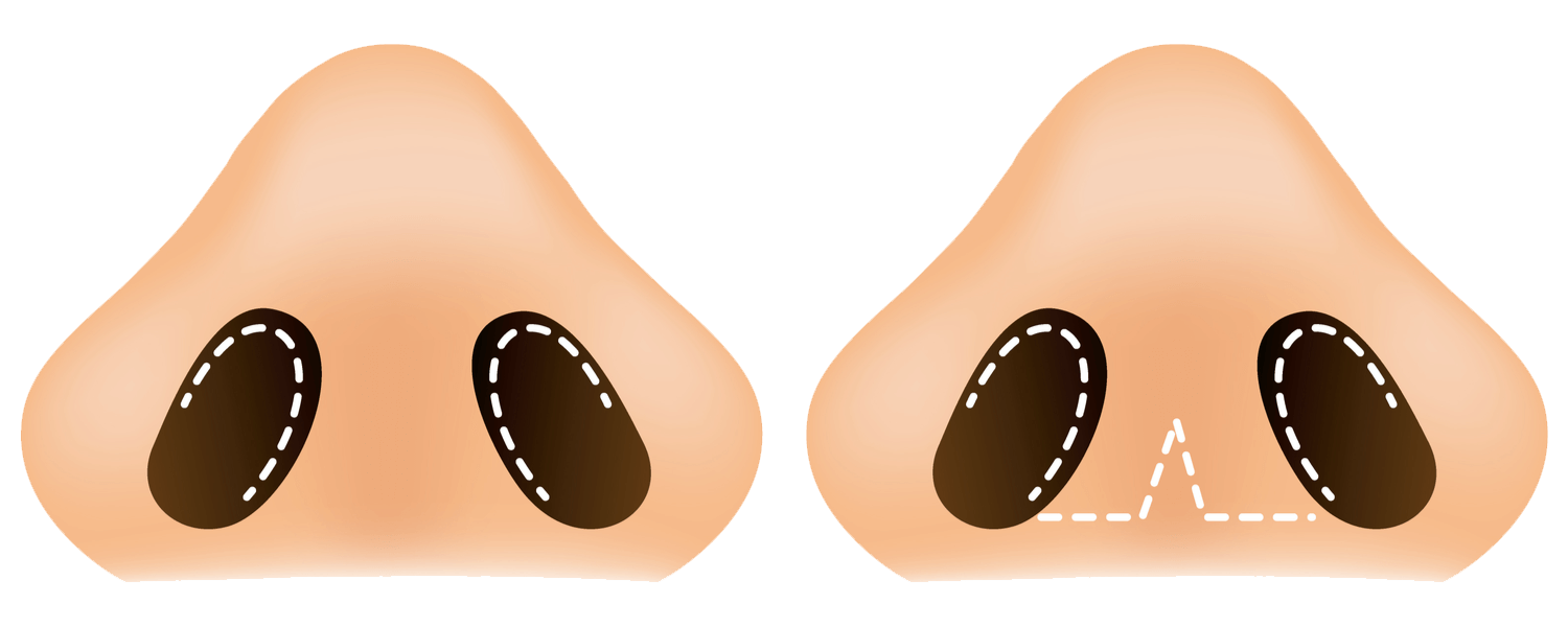 rhinoplasty-before-after