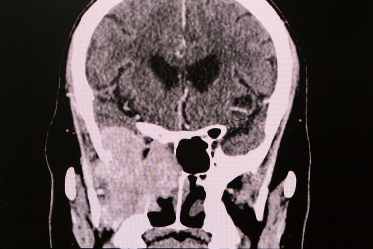 sinus-cancer-scan